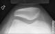 Kn�sk�l axial